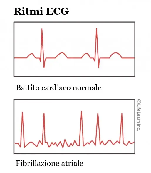 Ritmi ECG